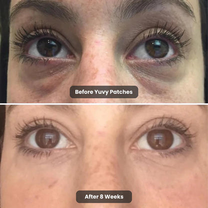 Microneedling Eye Patches by Yuvy
