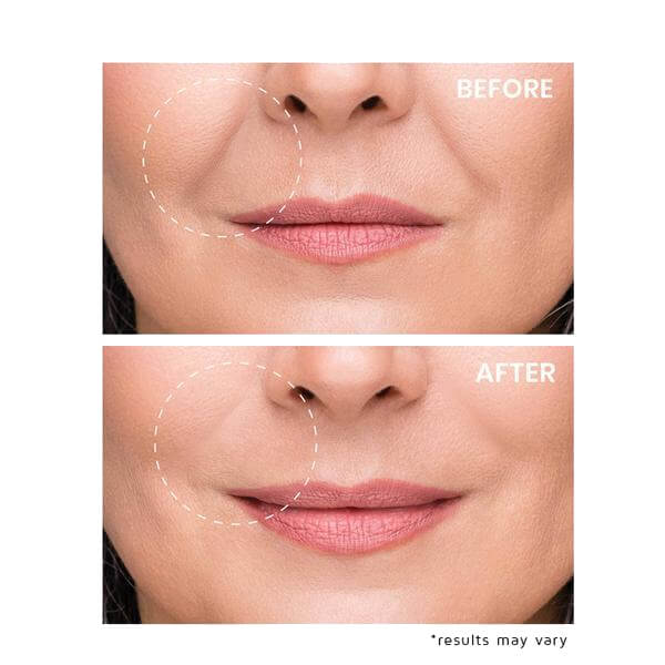 Microneedling Eye Patches by Yuvy